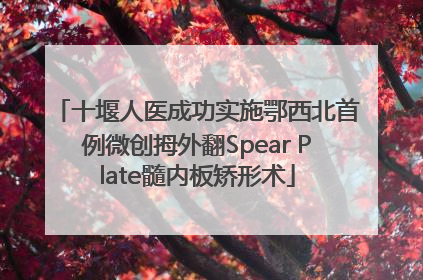 十堰人医成功实施鄂西北首例微创拇外翻Spear Plate髓内板矫形术